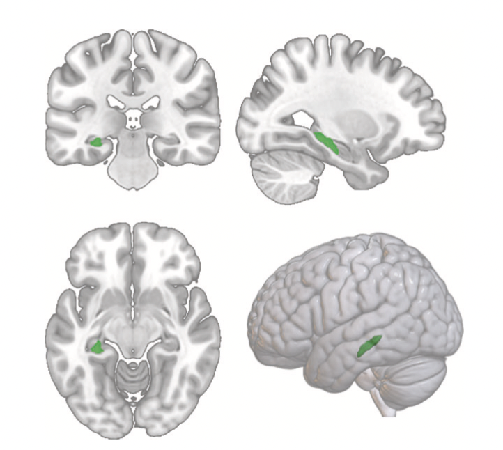 _kabro_'s tweet photo. 🎉Absolutely thrilled to finally share this with everyone: @FrederikeStein's and my paper on transdiagnostic GMV alterations in depression, bipolar disorder, and schizophrenia spectrum disorder is finally out ! 🎉
https://t.co/a3pm2GNaWi
Below a thread about our main findings: https://t.co/wxYqnIg3Xe