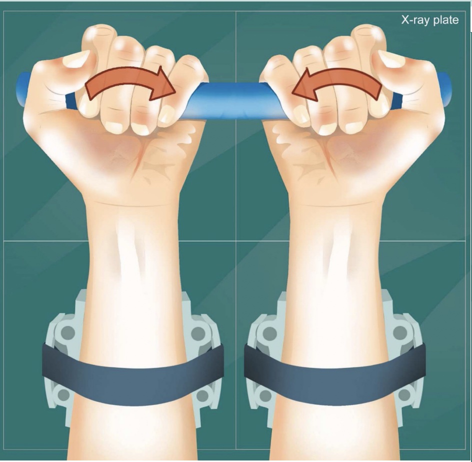 BgTalkinman's tweet image. The Bilateral Ulnar Deviation Stress (BUDS) Test for scapholunate ligament insufficiency - this could prove to be a very important plain radiographic test! Read about in the July issue of @JHandSurg #SLIL #wrist