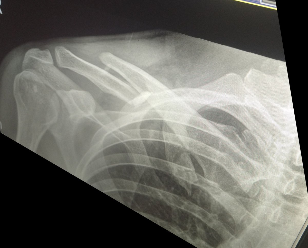 When your Sykkuno merch is shipping, but you broke your clavicle, and can only wear button up shirts...