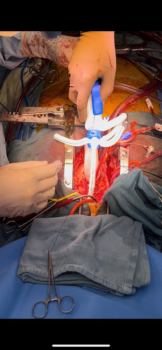 Chris Burke (@chrisryanburke) on Twitter photo Thrilled to participate in the first commercial Thoraflex FET implant on the West Coast! A great addition to the arsenal and slick deployment!! <a href="/TerumoAortic/">Terumo Aortic</a> <a href="/uwmtap/">UW Multidisciplinary Thoracic Aortic Program</a> #HuskyAorta #CardioTwitter #AortaEd Thrilled to participate in the first commercial Thoraflex FET implant on the West Coast! A great addition to the arsenal and slick deployment!! <a href="/TerumoAortic/">Terumo Aortic</a> <a href="/uwmtap/">UW Multidisciplinary Thoracic Aortic Program</a> #HuskyAorta #CardioTwitter #AortaEd