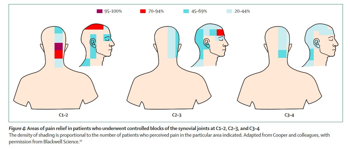 PhysioMeScience's tweet photo. Cervicogenic headache: an assessment of the evidence on clinical diagnosis, invasive tests, and treatment

🤕🤕🤕

https://t.co/vbvzc6TxIS https://t.co/fKYzYB6Mzy