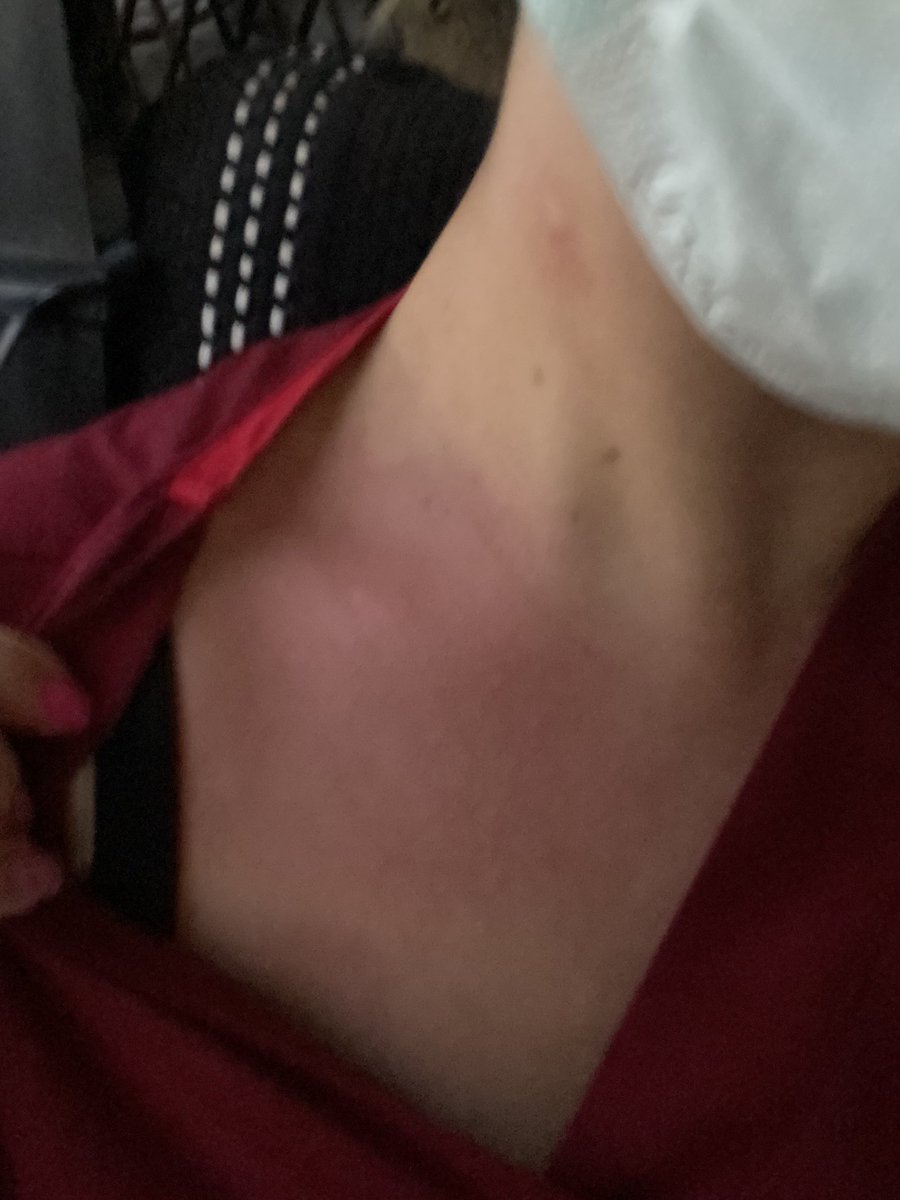 alevozgn's tweet photo. Size üzücü bi hikaye anlatacağım Nöbette hasta yakını tarafından hem darp hem tehdit edildim. Şikayetçi oldum ifademi alan polis memuru ‘sadece kızarmış bundan bişey çıkmaz’ dedi. :)) bişey çıkması için ne olması gerekiyo öldürülmem mi? @SaglikBirlikDer @drfahrettinkoca https://t.co/MaSfxguOx2