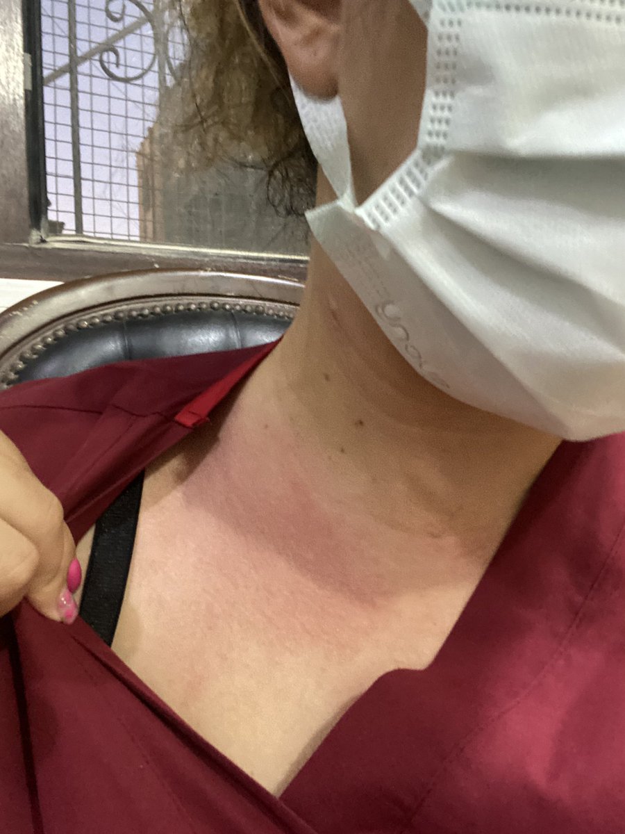 Size üzücü bi hikaye anlatacağım Nöbette hasta yakını tarafından hem darp hem tehdit edildim. Şikayetçi oldum ifademi alan polis memuru ‘sadece kızarmış bundan bişey çıkmaz’ dedi. :)) bişey çıkması için ne olması gerekiyo öldürülmem mi? @SaglikBirlikDer <a href="/drfahrettinkoca/">Dr. Fahrettin Koca</a>