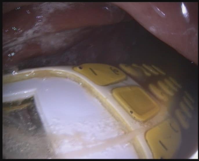 endoscopy_unit's tweet photo. #mobile_phones and endoscopy.
Accidental swallowing of mobile phones,
#Removal_by #endoscopy.
DR. MASFIQUE AHMED BHUIYAN FCPS LAPAROSCOPIC AND INTERVENTION ENDOSCOPIC SURGEON,
Dhaka, Bangladesh
email: shimondmc@gmail.c
Video Link
https://t.co/YHNpF9j2SL https://t.co/ek7I7sGFvv