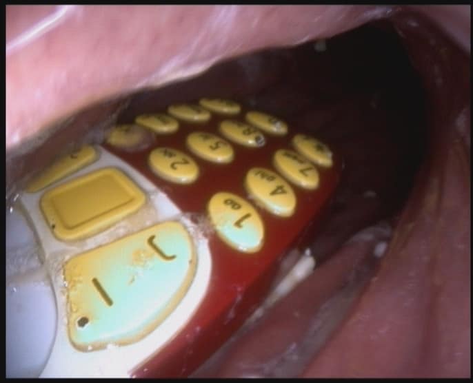 endoscopy_unit's tweet photo. #mobile_phones and endoscopy.
Accidental swallowing of mobile phones,
#Removal_by #endoscopy.
DR. MASFIQUE AHMED BHUIYAN FCPS LAPAROSCOPIC AND INTERVENTION ENDOSCOPIC SURGEON,
Dhaka, Bangladesh
email: shimondmc@gmail.c
Video Link
https://t.co/YHNpF9j2SL https://t.co/ek7I7sGFvv