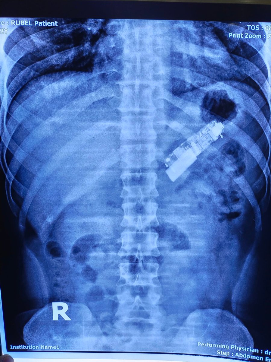 endoscopy_unit's tweet photo. #mobile_phones and endoscopy.
Accidental swallowing of mobile phones,
#Removal_by #endoscopy.
DR. MASFIQUE AHMED BHUIYAN FCPS LAPAROSCOPIC AND INTERVENTION ENDOSCOPIC SURGEON,
Dhaka, Bangladesh
email: shimondmc@gmail.c
Video Link
https://t.co/YHNpF9j2SL https://t.co/ek7I7sGFvv