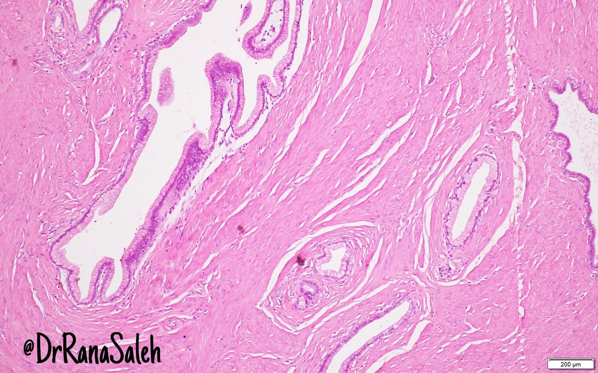 Rana Saleh, MD (@drranasaleh) on Twitter photo 2.5 cm nodule in the stomach antrum #gipath #pathresidence #pathclassics 2.5 cm nodule in the stomach antrum #gipath #pathresidence #pathclassics