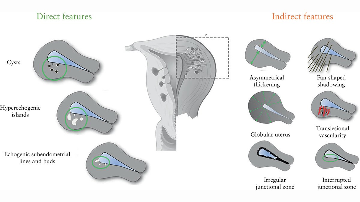 Read new #UOGJournal open-access Delphi study providing revised definitions of MUSA features of adenomyosis following consensus among 13 experts in ultrasound diagnosis of adenomyosis. Full article: bit.ly/39X2UDN #ISUOG #LoveUltrasound