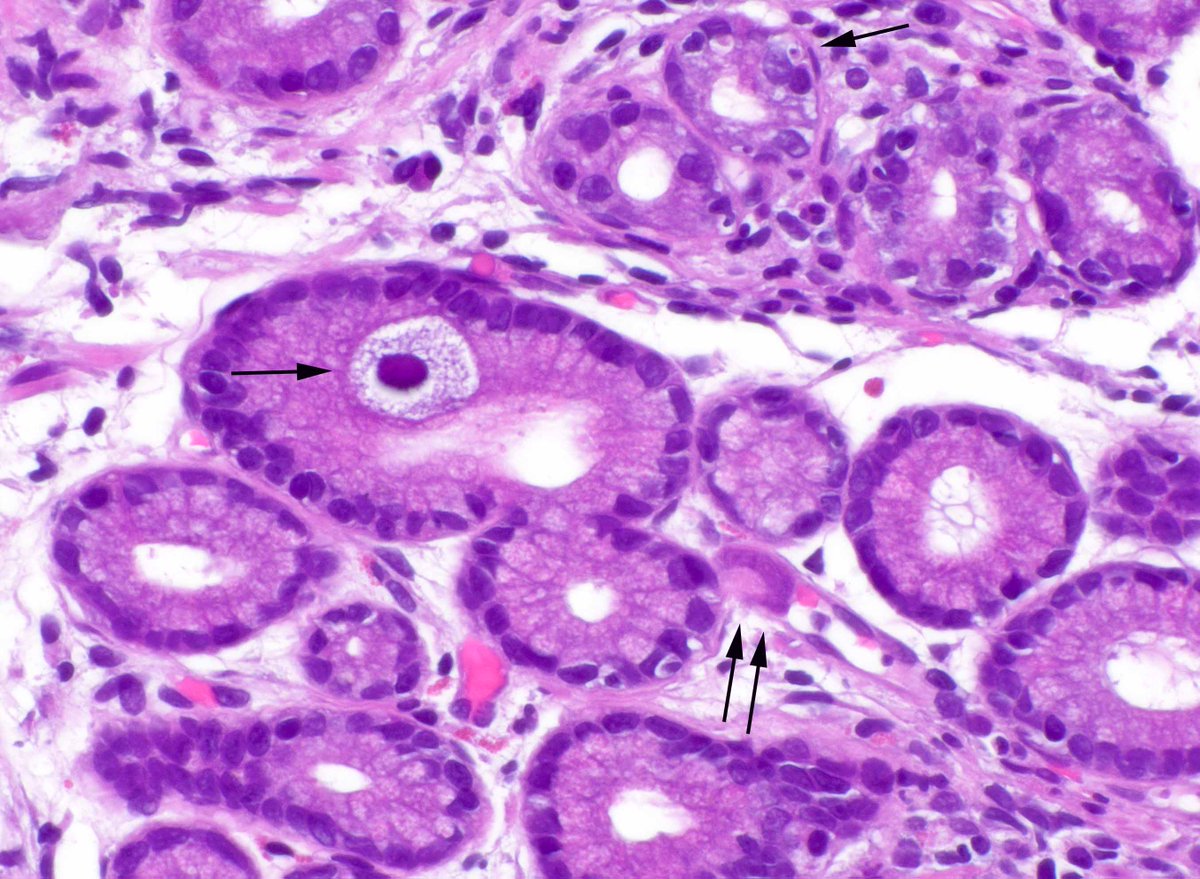 Cytomegalovirus (CMV) gastritis and colitis.  Arrows show the stromal colonic viral cytopathic effect. Two arrows show an infected gastric endothelial cell and one shows an infected epithelial cell. The top arrow in the gastric biopsy shows apoptosis, often associated with CMV.