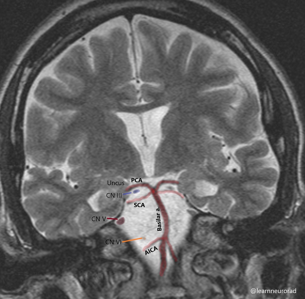 Cranial nerve anatomy to help understand why uncal herniation and Pcomm aneurysms result in a fixed and dilated pupil. CN III and IV run b/w the PCA &amp; SCA. CN V and VI run in the prepontine cistern, lateral to the basilar artery. #Neurorad #radres #Neurotwitter #MedEd #MedTwitter