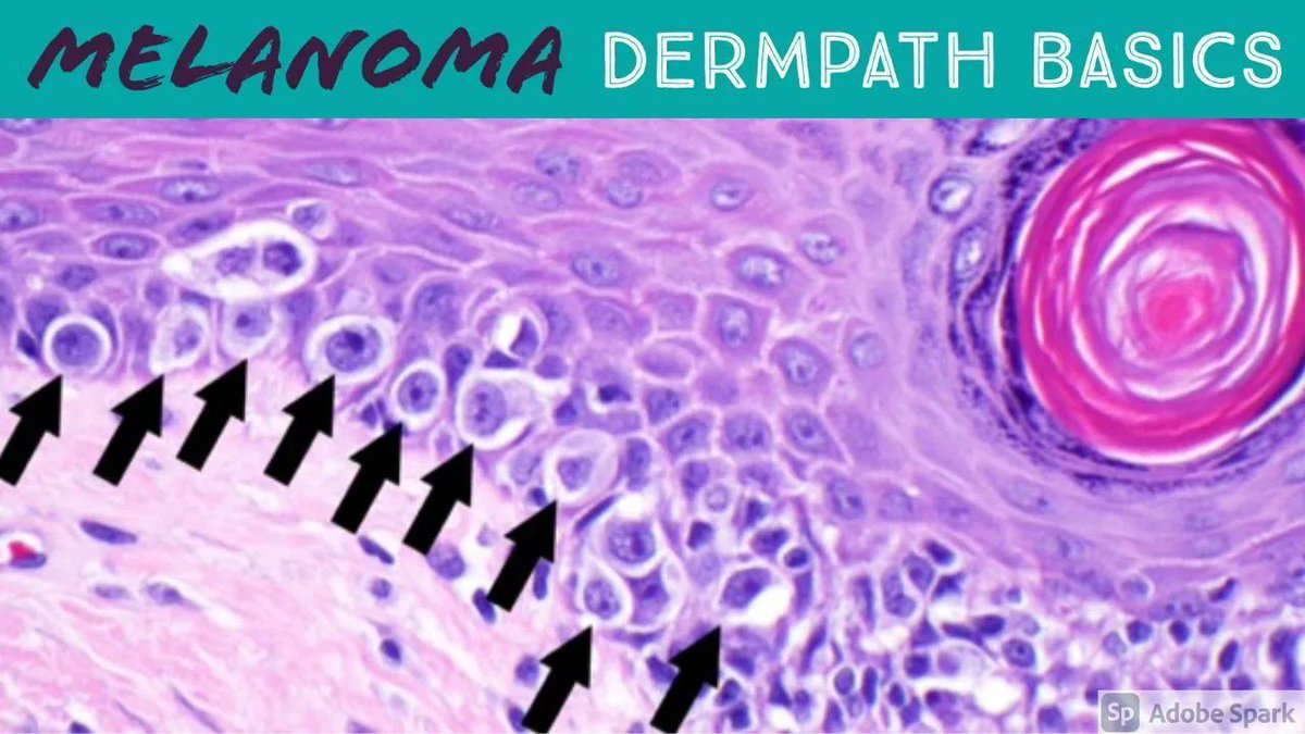 How do you distinguish Melanoma vs Nevus? Here are my top microscopic clues for melanocytic malignancy (explained in 5 minutes): kikoxp.com/posts/6063.  #pathology #pathologists #pathTwitter #dermpath #dermatology #dermatologia #dermtwitter