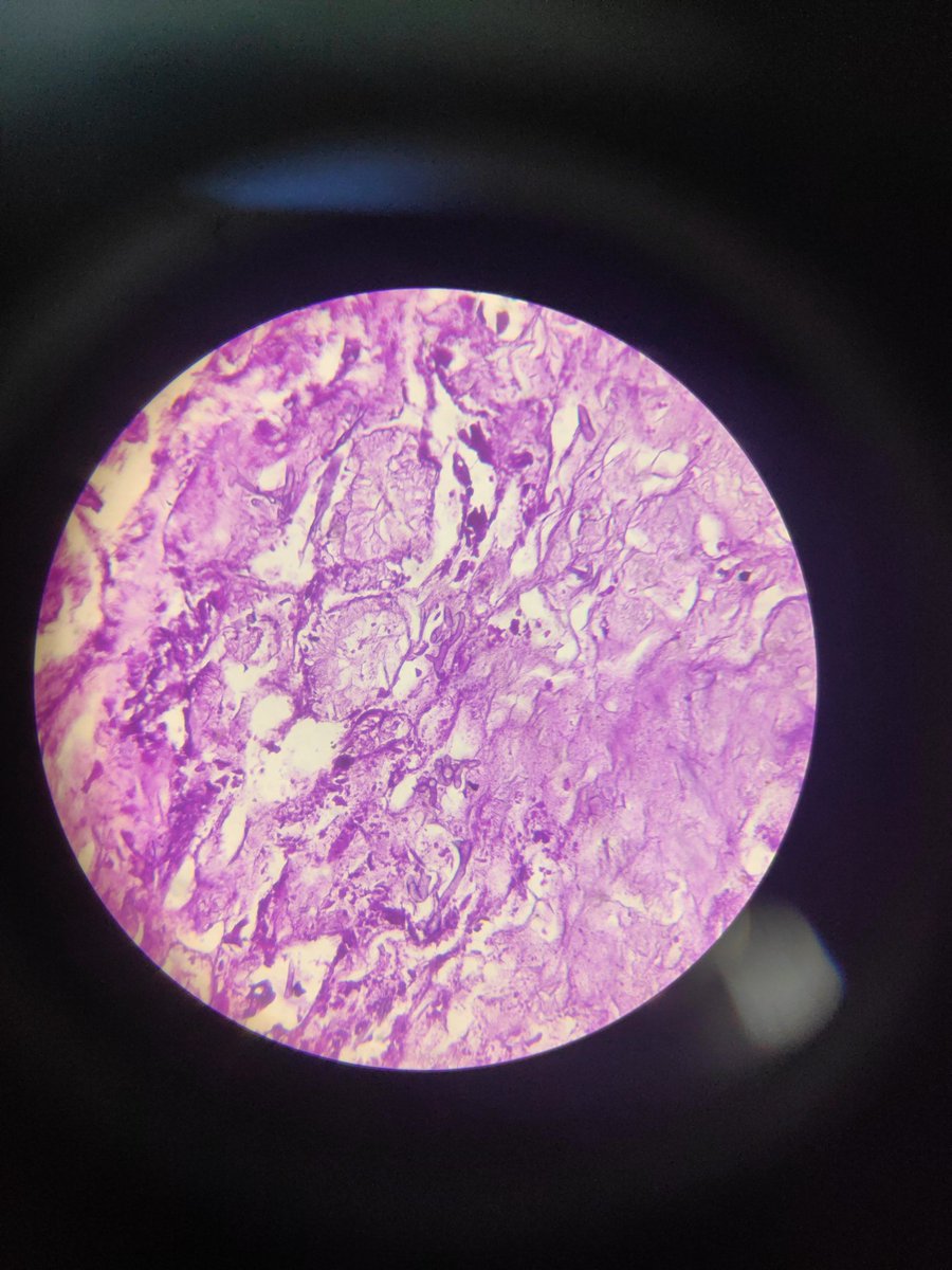 Shruti79688953's tweet photo. Adult male history of accident
#mucormycosis #pathtwitter #pathlove https://t.co/hrmr4oXwPW