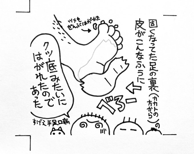 「手足口病」またこの夏も流行ってると聞いて。5〜6年前に子供経由でかかって(子供は軽くすんだんだけど)熱出て体中腫れ上がって寝込んで…やっと治った後、こうなります、というコミックビームに描いたイラスト。 
