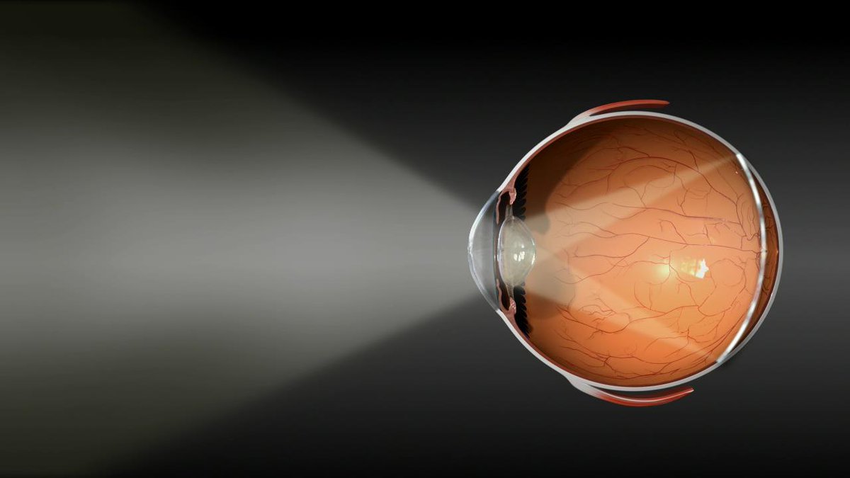 RayLewis_Opt's tweet image. ow.ly/9I9e103QXKb ow.ly/CVrm103RiLX Role of corneal radius of curvature in early identification of fundus tessellation in children with low myopia - British Journal of Ophthalmology