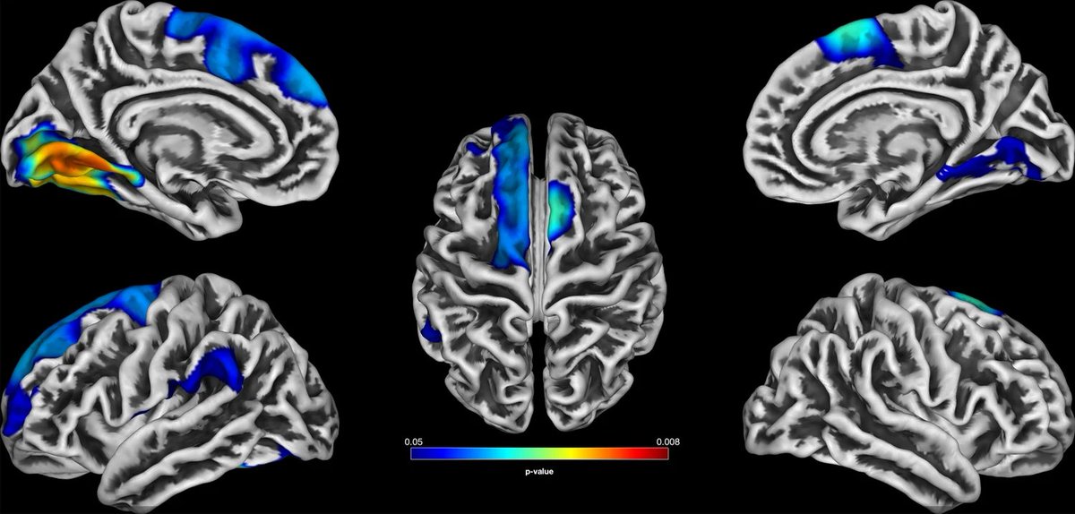 New paper alert: 
Schmitt and colleagues demonstrate that gyrification is related to gestational age and neurocognitive performance in healthy adults. Gestational age moderates the association of local gyrification and cognitive performance
#FOR2107 

doi.org/10.1007/s00406…