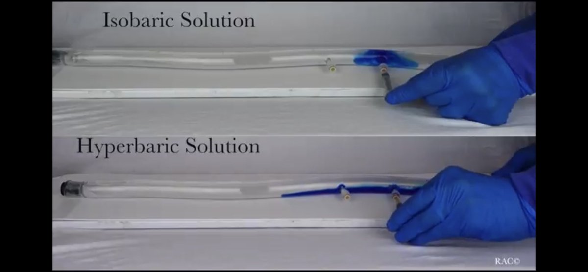 Glass Spine Model Demonstrating Local Anesthetic Baricity for Hyperbaric... youtu.be/rFAyTRvMBOE vía @YouTube