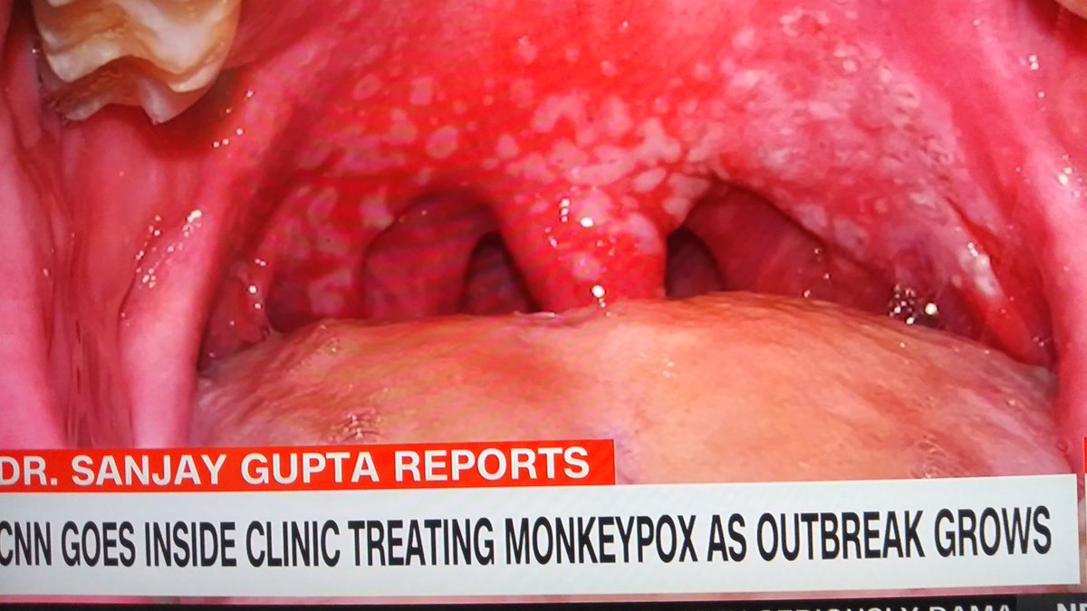 Image of Monkeypox in the back of a patients throat. Also 25% will develop lesions on their eyes, if it spreads to their cornea it can cause blindness.