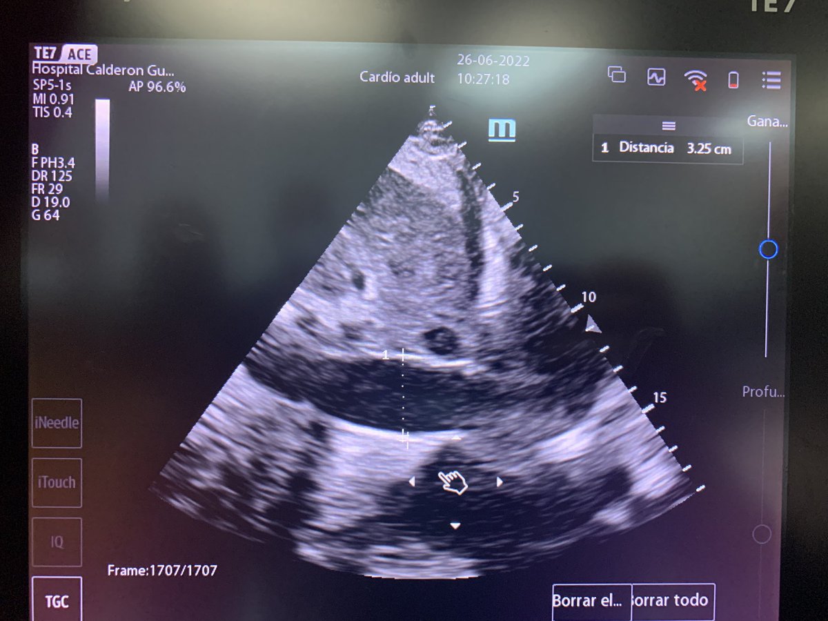 Derrame pleural bilateral + VCI pletórica = nefropatía - insuficiencia cardiaca - hepatopatía ?. La clave nos la dará la historia clínica y examen físico . Lo que no hay duda es que el paciente tiene sobrecarga hídrica.
