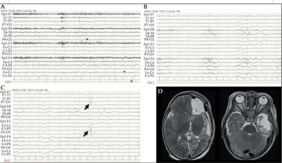 No need to perform an EEG after hemispherectomies, if patient seizure free, EEG abnormalities in operated hemisphere do not preclude tapering off ASM!!!! @AMoosaMD great team work! @EpiDisorders @yesILAE bit.ly/3oA3eMe