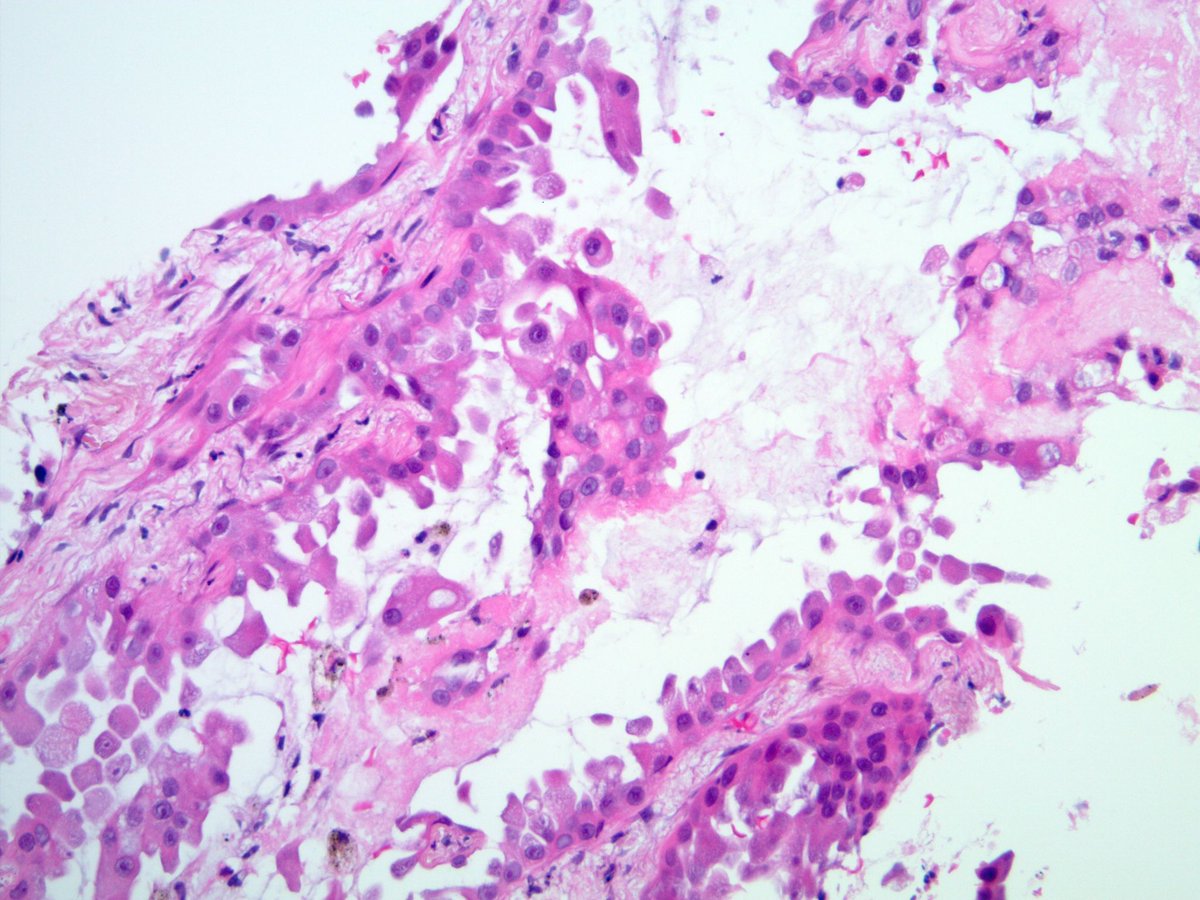 Adult smoker with solitary lung nodule has this histology. No history of malignancy. Let’s say TTF-1 is negative. How would you diagnose this? I’m curious to hear the exact wording. #pathology #pulmpath