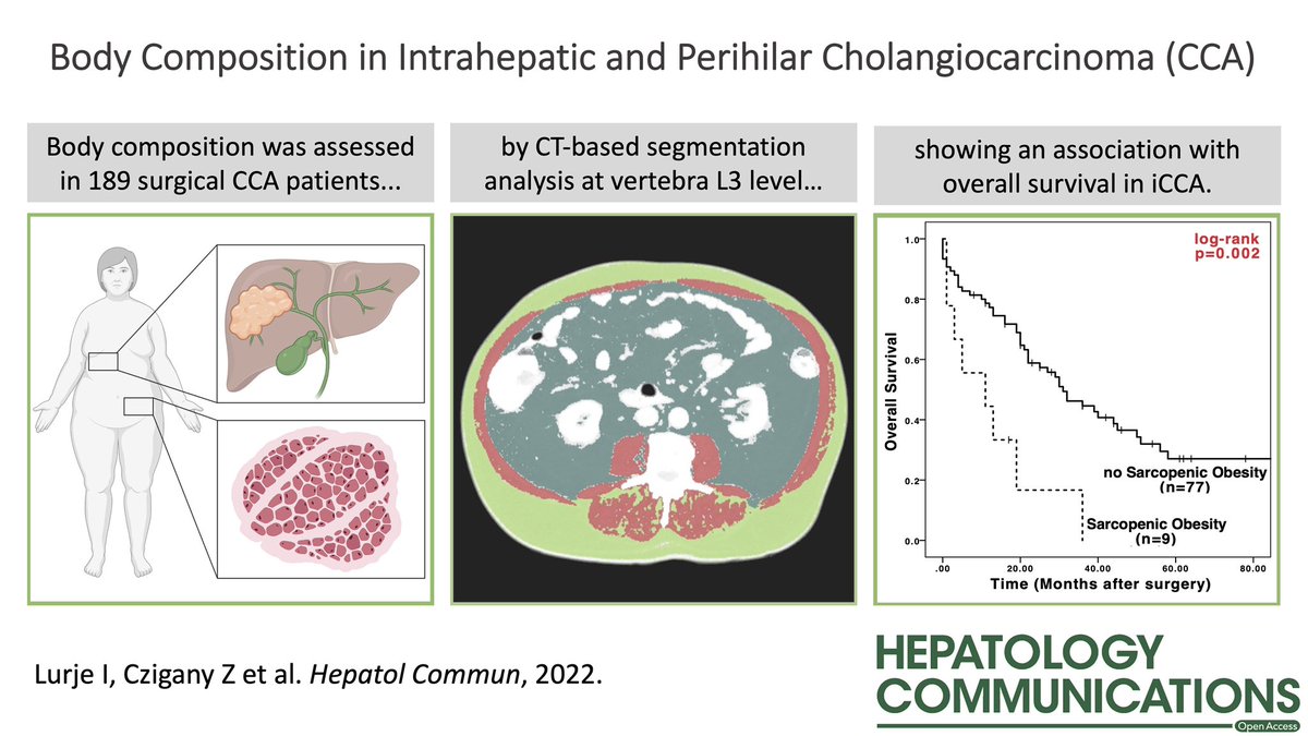 New 📃 looks at the association of body composition with outcomes after liver resection for #cholangiocarcinoma   #SarcopenicObesity may impact survival in patients with iCCA doi.org/10.1002/hep4.2… #LiverTwitter #OpenAccess #VisualAbstract