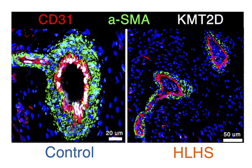 CircRes's tweet image. Yu et al revealed defects in #KMT2D-#NOTCH signaling contributed to impaired growth &amp;amp; remodeling of coronary #AECs in #HLHS which may lead to a potential therapeutic target for heart #regeneration and repair. ahajrnls.org/3be8eDr 
@MingxiaGu @seema_mital @Wanleon_wn