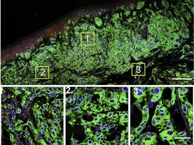 Men with metastatic #melanoma don’t live as long as women, and their tumors are more likely to become resistant to commonly used treatments. A new study may help to explain why. cancer.gov/news-events/ca…