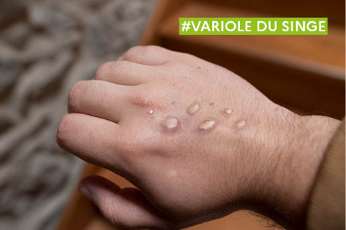FredericGoyet's tweet photo. Face à la #Varioledusinge la coopération de tous les acteurs est cruciale, pour informer, orienter, accompagner, soigner, prévenir. @ARSIDF réunit les acteurs communautaires pour, ensemble, mieux répondre aux attentes de tous les publics concernés. Merci à tous et à toutes. https://t.co/DB3EhPvvHB