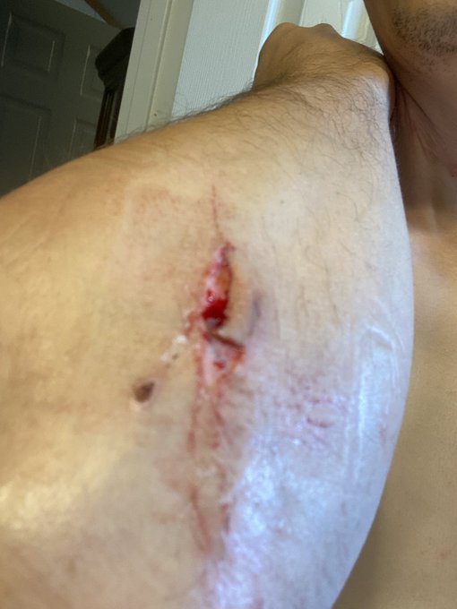 I&rsquo;m on a fucking roll. Todays boo-boo https://t.co/pbWHquowe8