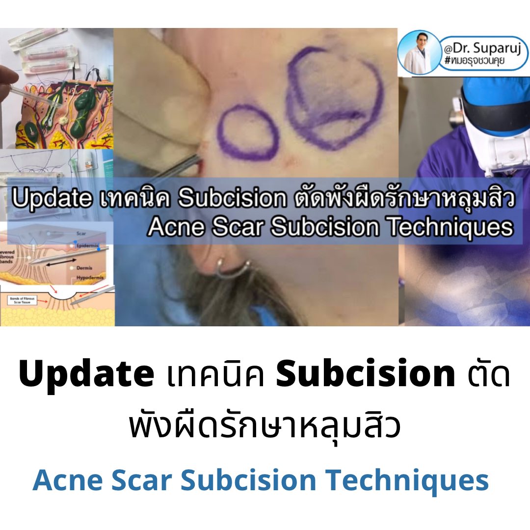 DrSuparuj's tweet photo. 📍Update เทคนิค Subcision ตัดพังผืดรักษาหลุมสิว Acne Scar Subcision Techniques
🔬หลุมสิวโดยเฉพาะRolling acne scar ที่มีพังผืด Fibrosis มากการดูแลหลักคือการตัดพังผืดที่ดึงรั้ง #ตัดพังผืดหลุมสิว #Subcision Update เทคนิคตามใน link เลยครับ 👉https://t.co/XAbVVm5IJL https://t.co/AlwMpzFtZY
