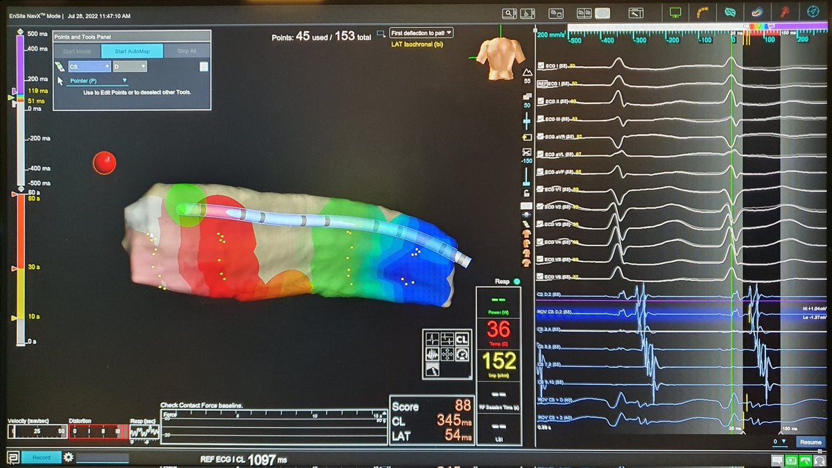 Great few days learning #EnSiteX from the EP guru himself <a href="/TerryCZWebb/">Terry Webb</a>. Big thanks to <a href="/AbbottCardio/">Abbott Cardiovascular</a> for facilitating. The start of an exciting collaboration between Barts and the JR! 10s CS map of oAVRT ablated in NavX mode. <a href="/Dr_Mark_Davies/">Mark Davies</a> @AliKirkpatric12 <a href="/JohnsNeville/">Neville Johns</a> #EPeeps