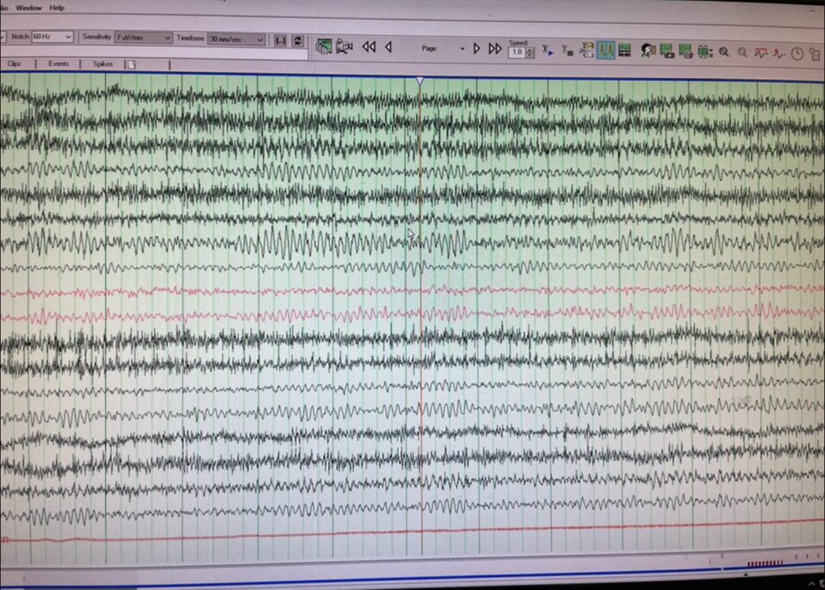 uabneurores's tweet photo. Nice PDR...and hair 😜 Our residents on peds are maybe all play and no work? Thanks for helping the techs over at CoA learn how to place EEGs!
#uab #neuroresidents #neurology #pedsneuro #childrensofalabama #uasom #neuro #epilepsy #eeg https://t.co/pokgvl042b