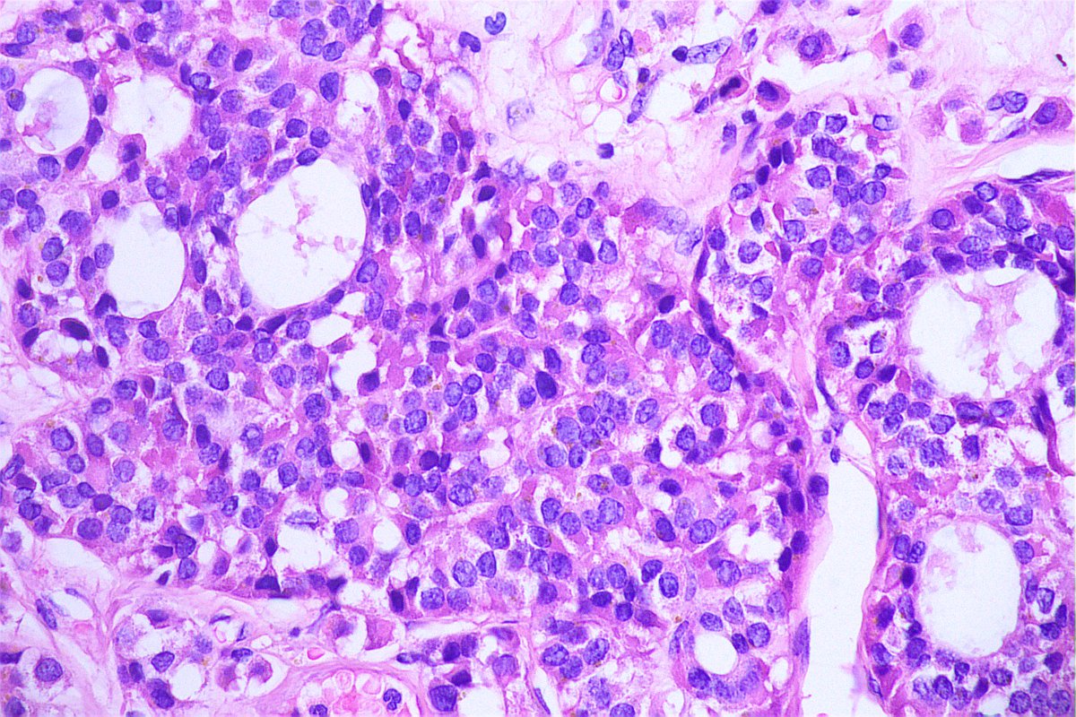 Nice case of MIDDLE EAR ADENOMA.

#entpath #pathology
