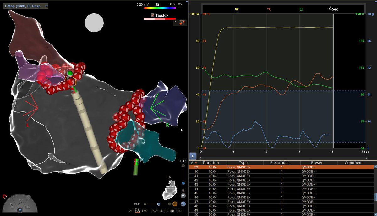 CadizEp's tweet photo. Excited to perform the first AF ablation using the #QDOT MICRO catheter in our lab.  A great experience.  Thanks to the @BiosenseWebster team, @JNJNews and @JuanPabloBW1.  The first of many.
#EPeeps #EP_Bot #HUPM #Cádiz https://t.co/8iEWFIRcwt