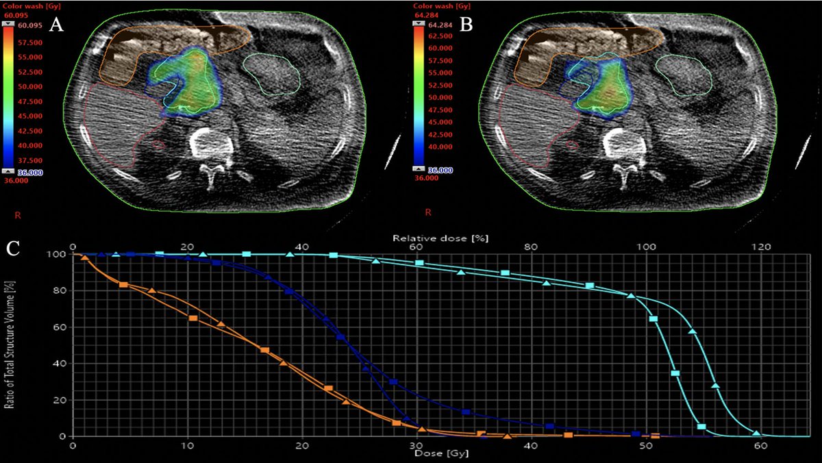 'In the #RedJournal: CT-guided stereotactic adaptive radiotherapy (CT-STAR) for the treatment of abdominal oligometastases was feasible in silico and dosimetrically superior to CT-guided non-adapted SBRT. @JoshuaSchiffMD @HayleyStoweMD @APrice_BeamOn ➡️ bit.ly/Schiff_2022 '