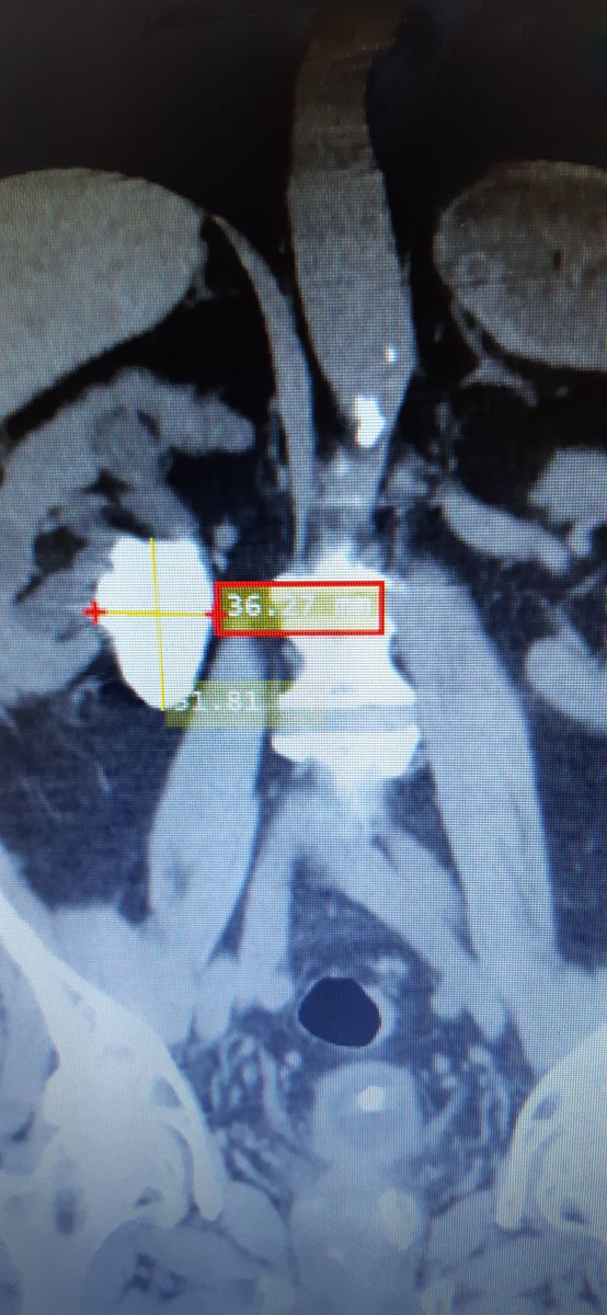 Standard PCNL, MINIPERC, RIRS? 72 years old. Revurrent UTI . PREVIOUS PCNL LEFT SIDE