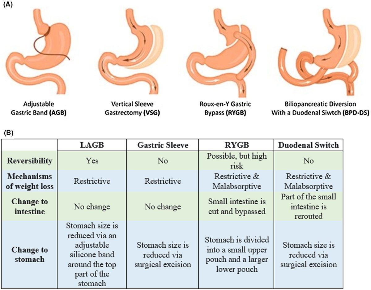 ClinicalLiverDisease (@cld_learning) on Twitter photo Improvement in nonalcoholic fatty liver disease through bariatric surgery
<a href="/AASLDtweets/">AASLD</a> #livertwitter #CLDSoMeReps <a href="/NancyReau/">Nancy Reau</a> <a href="/UyenTo2/">Uyen To</a> <a href="/Julius__Wilder/">Julius Wilder MD PhD</a>
Article👉 ow.ly/8xkk50K5I2W
Author interview👉 ow.ly/2j7W50K5I2X Improvement in nonalcoholic fatty liver disease through bariatric surgery
<a href="/AASLDtweets/">AASLD</a> #livertwitter #CLDSoMeReps <a href="/NancyReau/">Nancy Reau</a> <a href="/UyenTo2/">Uyen To</a> <a href="/Julius__Wilder/">Julius Wilder MD PhD</a>
Article👉 ow.ly/8xkk50K5I2W
Author interview👉 ow.ly/2j7W50K5I2X