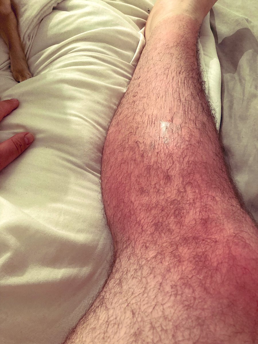 GayCockDrama's tweet photo. Be warned when your Scottish and you go out for the day because you don’t feel like your burning dos not mean your not hahahah it dos not look much on the photos but you can cook a egg on these bad boys haha #Sunburn #sun https://t.co/DnWCjIa32r