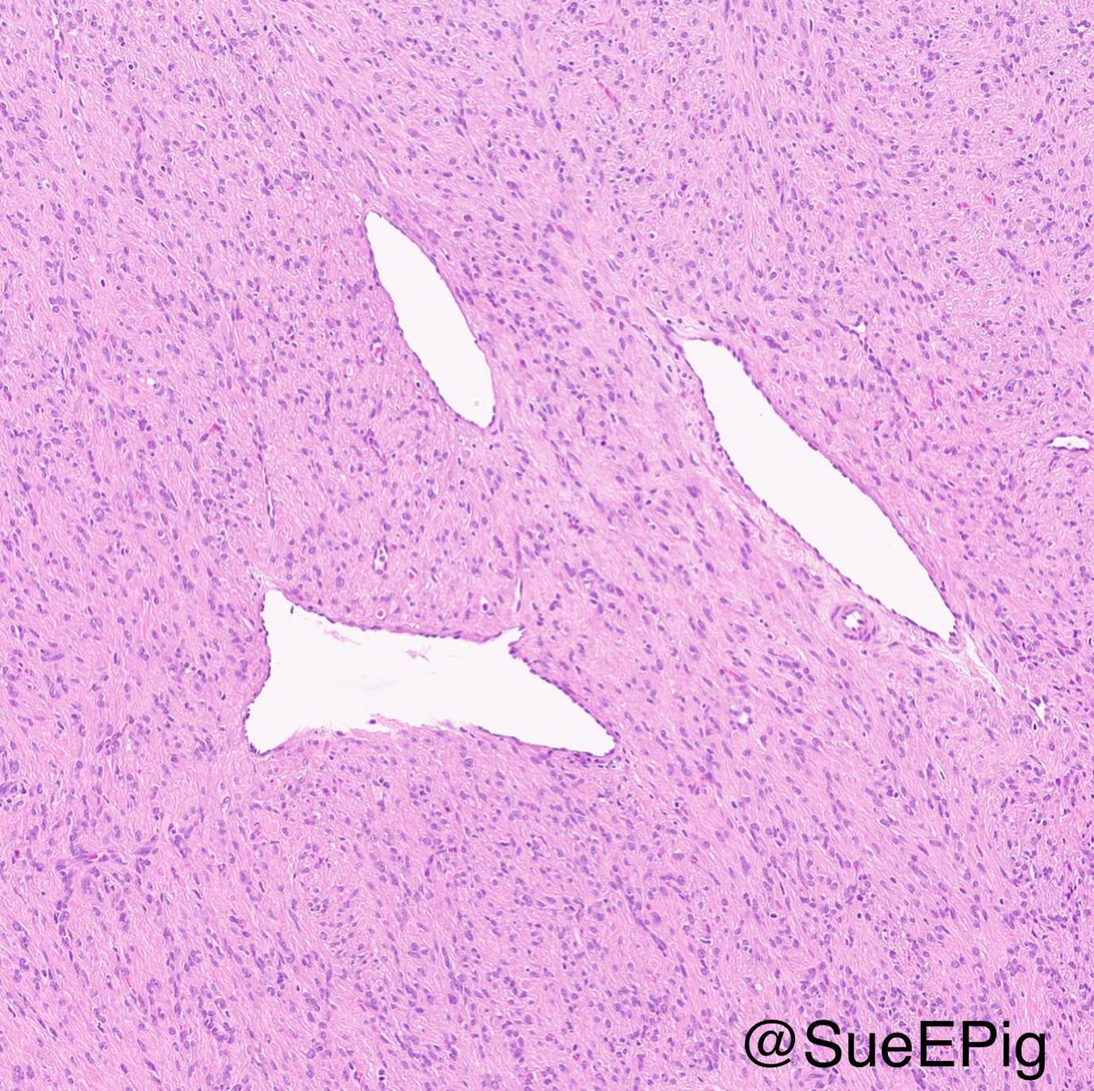 SueEPig's tweet image. Submitted as uterine fibroids, largest measures 6.8 cm, up to 2 mitoses/10 HPF, no coagulative tumor cell necrosis 🎨desmin and h-Caldesmon positive #gynpath #surgpath