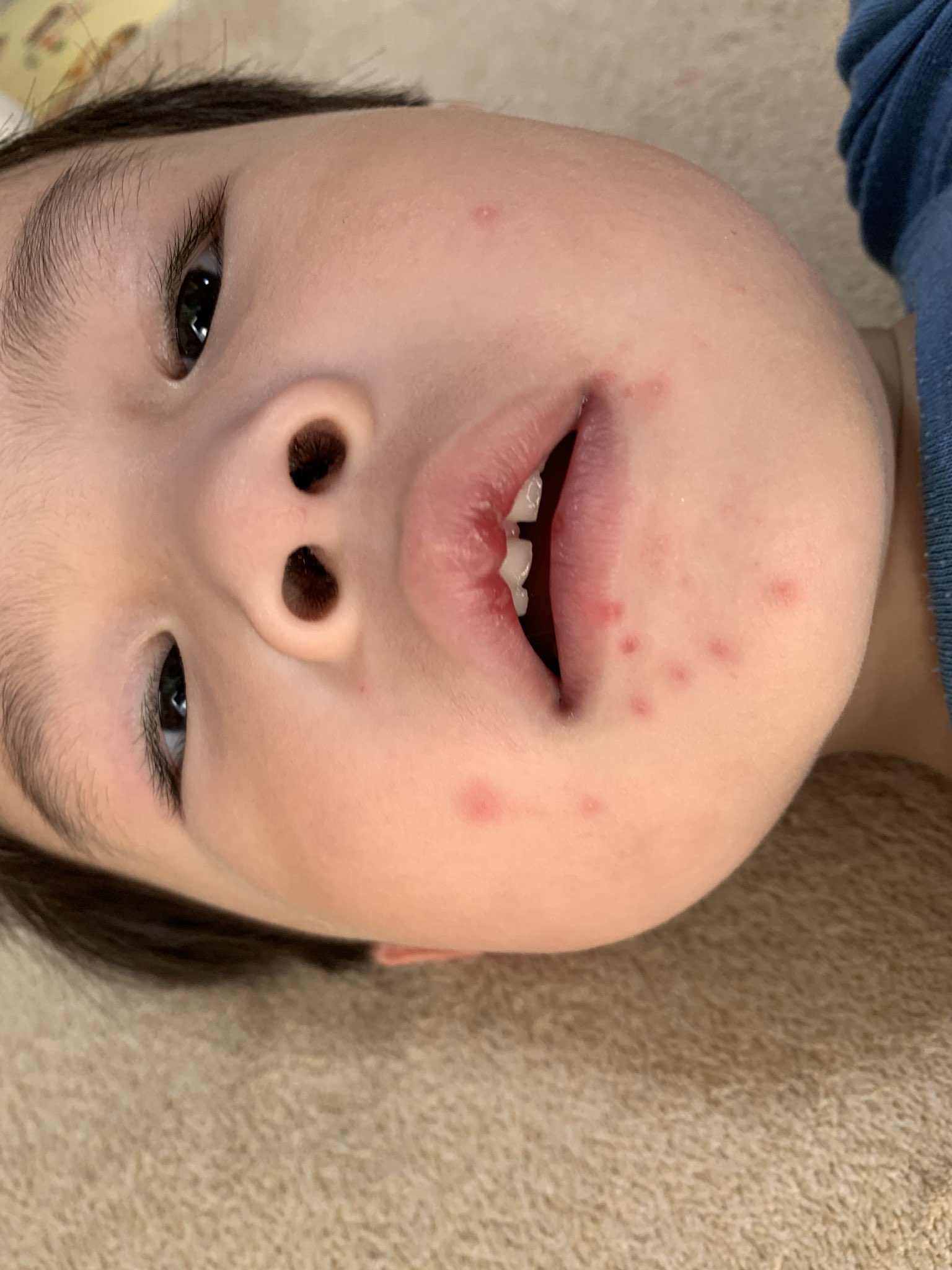 さすけまま 先週からずっと体調不良だった原因は手足口病でした ポツポツが出てきたら終了のサインとの事 確かにまだポツポツはあるけど 元気になりました ただでさえ偏食で細いのに 1kg痩せちゃった 手足口病 手足口病画像 T Co