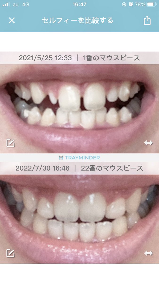 pcpph8888's tweet photo. インビザライン22枚、1年と2ヶ月を経て完走しました！！！！！！
そして今日人工歯をぶっさしてもらって、矮小歯と��おさらば👋🏻
見違える歯になりました🦷 ✨

医療の力、す��い！！！！！！！！ https://t.co/l3XVUCuiRi