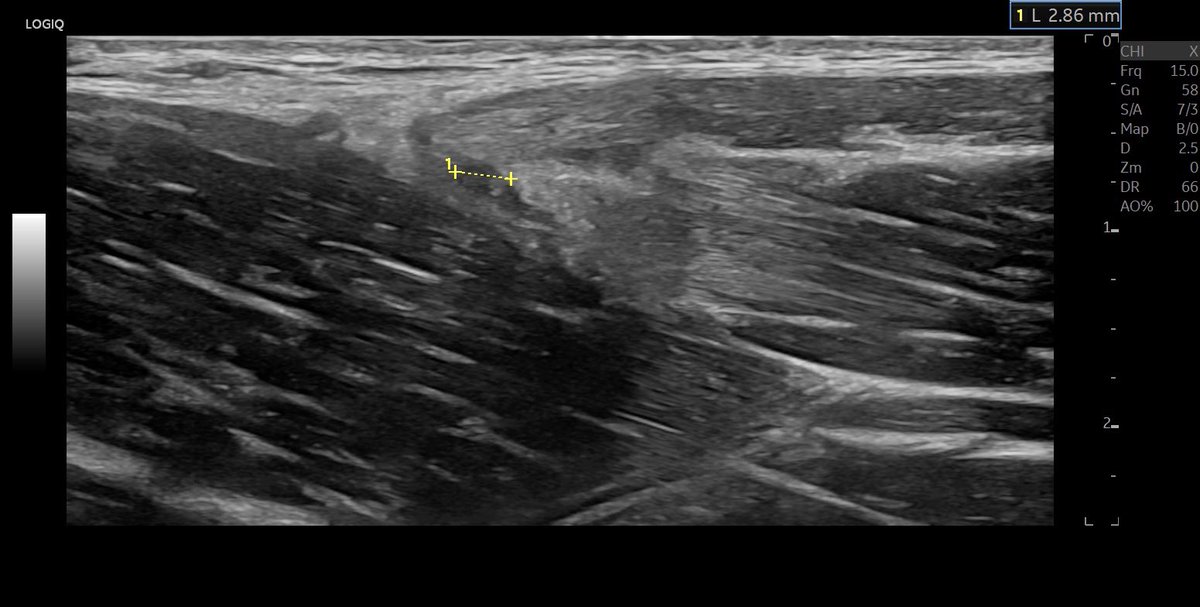 SportklinikBern's tweet photo. Comparison of the #vscanair (first 2 Pics marked with green “V”) vs #GElogiqE10r3 of a small #muscletear of the #adductorlongus. Pretty good for a mobile device but it’s a superficial injury #mskus #pocus #pocushub #sportsinjyry #onfieldultrasound https://t.co/wUqExyllUg