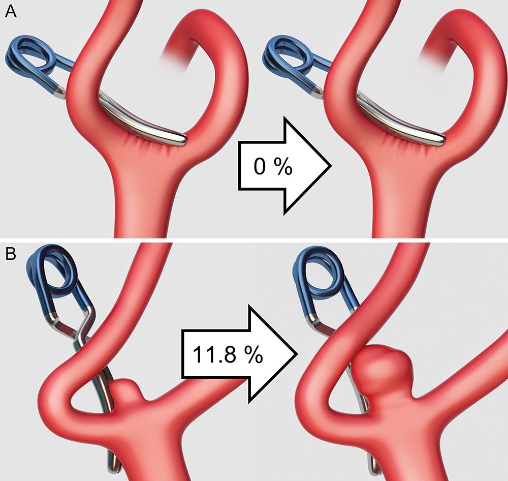 3D DSA useful in predicting aneurysm recurrence after clipping! Check out this new online first article in @TheJNS #aneurysm bit.ly/3S84bcx