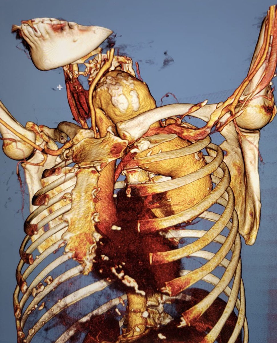 wong_randolph's tweet photo. Cervical aortic arch and descending aneurysm treated with single stage TAR FET #artivion#E-vita Open Neo https://t.co/WqL48lnYCY