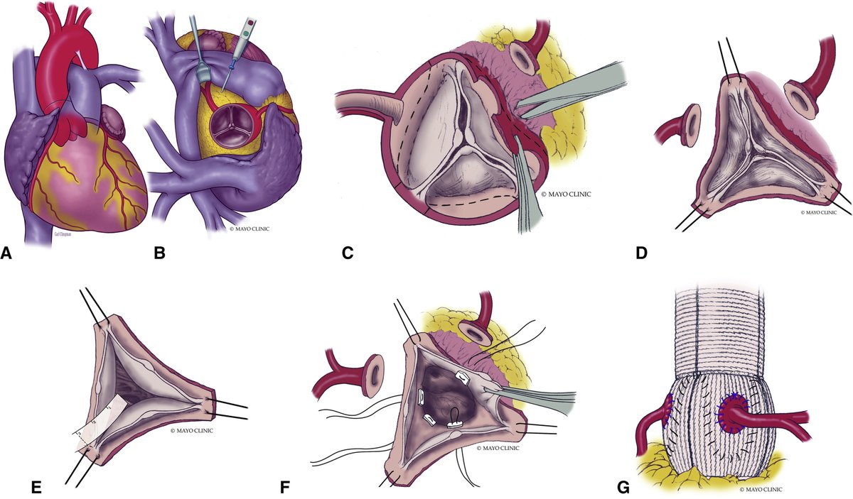 Outcomes and risk factors of late failure of valve-sparing aortic root replacement. Read the full JTCVS article by <a href="/SriPatlolla/">Sri Harsha Patlolla, MBBS, MS</a>, Pochettino, et al: doi.org/10.1016/j.jtcv… #JTCVS #CardioTwitter #CTSurgery #cardiacsurgery #cvsurg <a href="/AATSHQ/">AATS</a> <a href="/tssmn/">CTSurgSocMedNetwork</a>