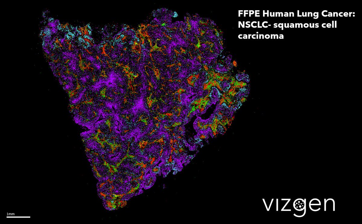 In 2020, 12.2% of all new cancers worldwide were #LungCancer! This #MERSCOPE data image of FFPE human #NSCLC #SquamousCellCarcinoma tissue highlights 5 key cancer genes from a 500 #MERFISH gene panel. Explore the #TME: hubs.ly/Q01hWpWy0

#WorldLungCancerDay #CancerTwitter