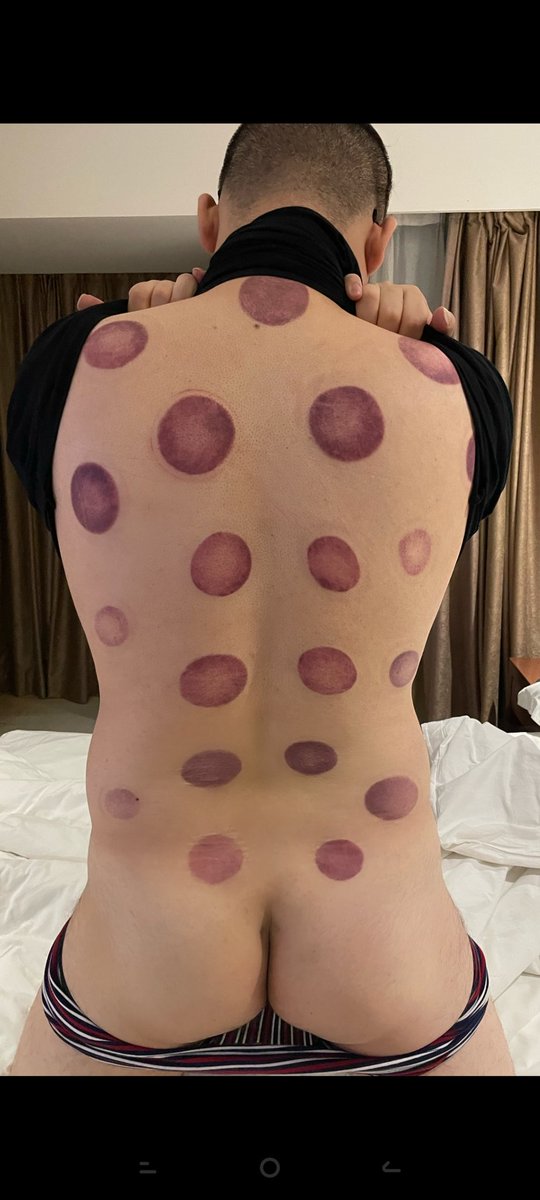 mana960804's tweet photo. 变身七星瓢虫🐞，第一次拨火罐，爱喝冷的我果然湿气重 https://t.co/SOV9ja2gVj