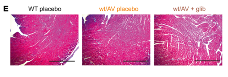 CardioCaribeMx's tweet photo. Sx Cantu
mut KCNJ8👉canal Kir6.1/SUR2 ⬆️función
Expresión en musc vascular 👉 vasodilatación permanente
Glibencamida inhibe Kir6.1/SUR2👉regresión de hipertrofia cardiaca 👉⬆️RVS ⬆️presión arterial

*Kir6.1 no abunda en cardiomiocitos
DOI: 10.1172/JCI130571
#CRISPR #glibencamida https://t.co/SLjjBFYJ2q