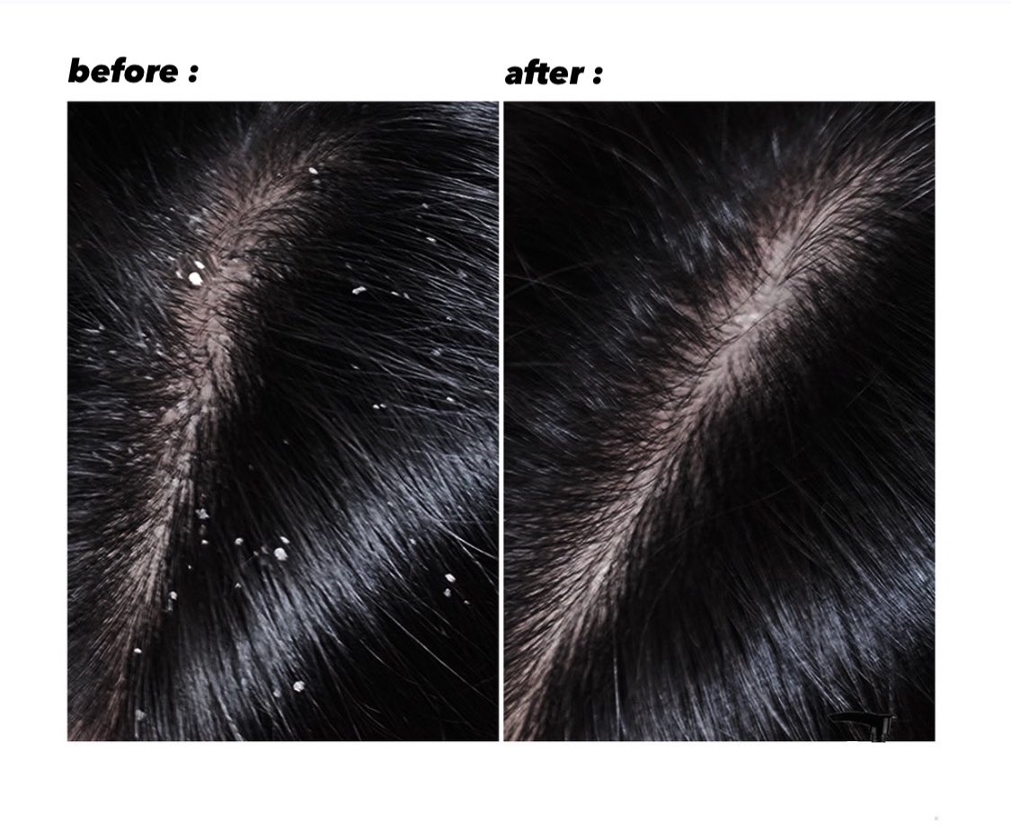 Kumpulan shampo anti ketombe paling ampuh

a thread