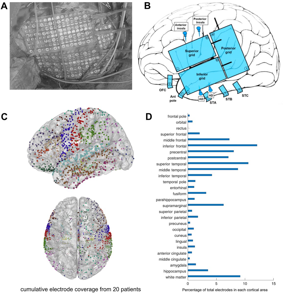 #OnlineFirst: Modern intracranial electroencephalography for epilepsy localization with combined subdural grid and depth electrodes with low and improved hemorrhagic complication rates thejns.org/view/journals/…